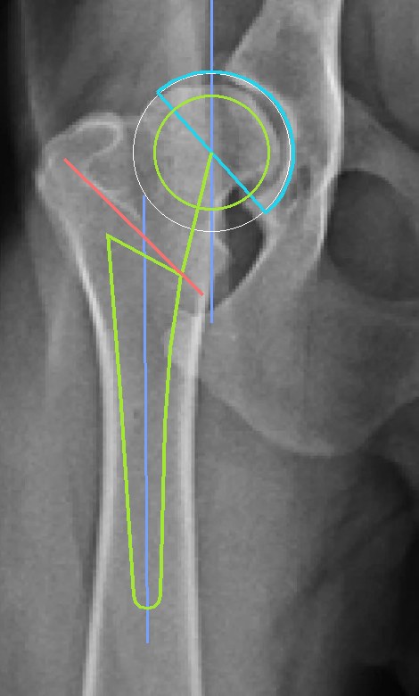 Molde de prótese total de quadril na radiografia VD: taça, haste, cabeça e corte do colo